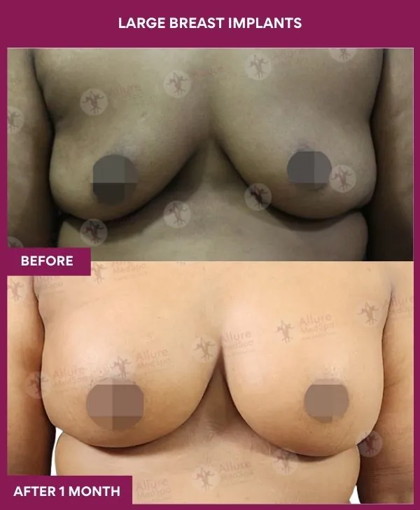large-breast-implant-before-after-results-mumbai-india-patient03-front