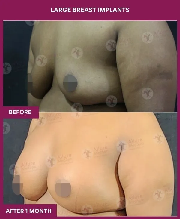 large-breast-implant-before-after-results-mumbai-india-patient03-side-left