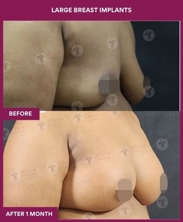 large-breast-implant-before-after-results-mumbai-india-patient03-side-right