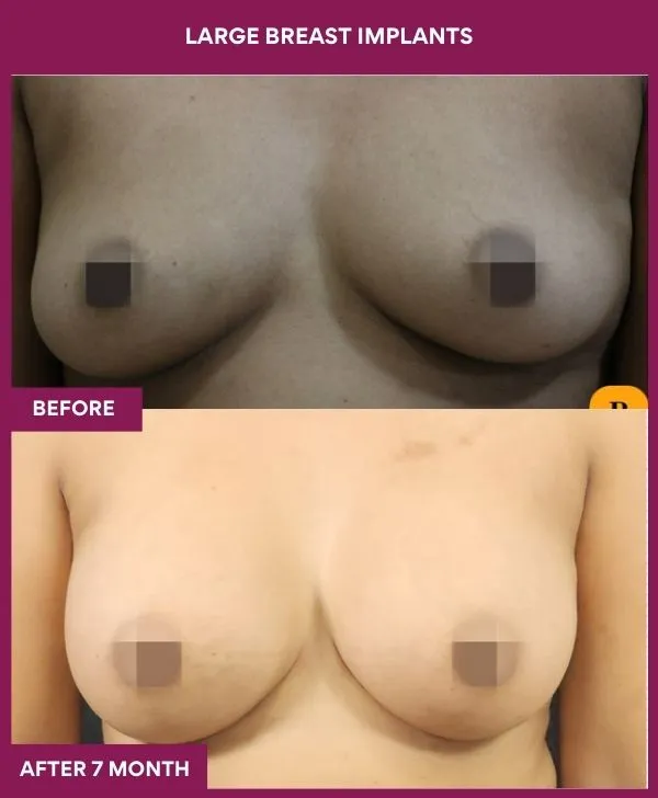 large-breast-implant-before-after-results-mumbai-india-patient04-front