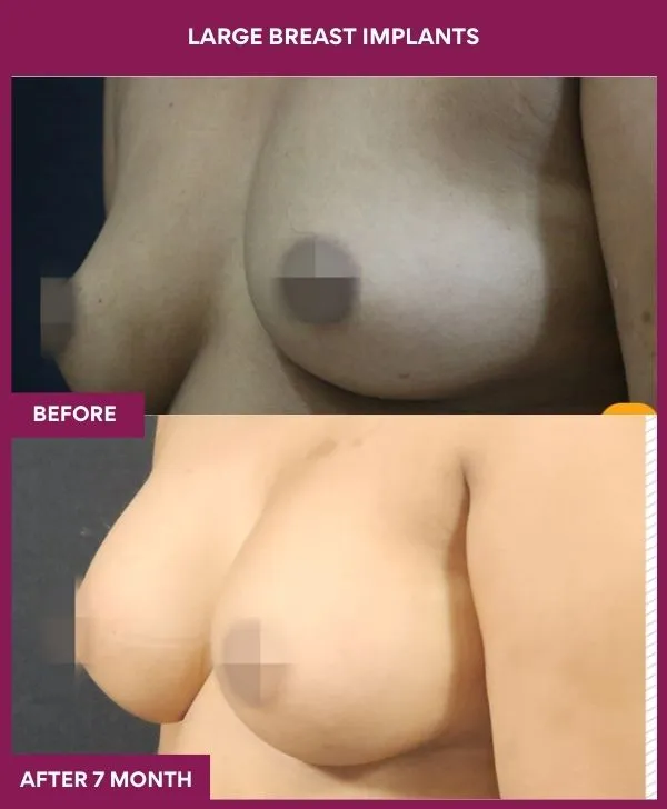 large-breast-implant-before-after-results-mumbai-india-patient04-side-left