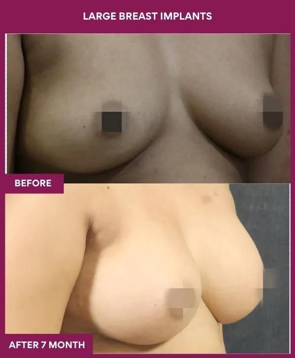 large-breast-implant-before-after-results-mumbai-india-patient04-side-right