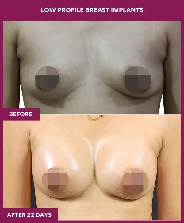 low-profile-breast-implants-before-after-results-mumbai-india-patient01-front