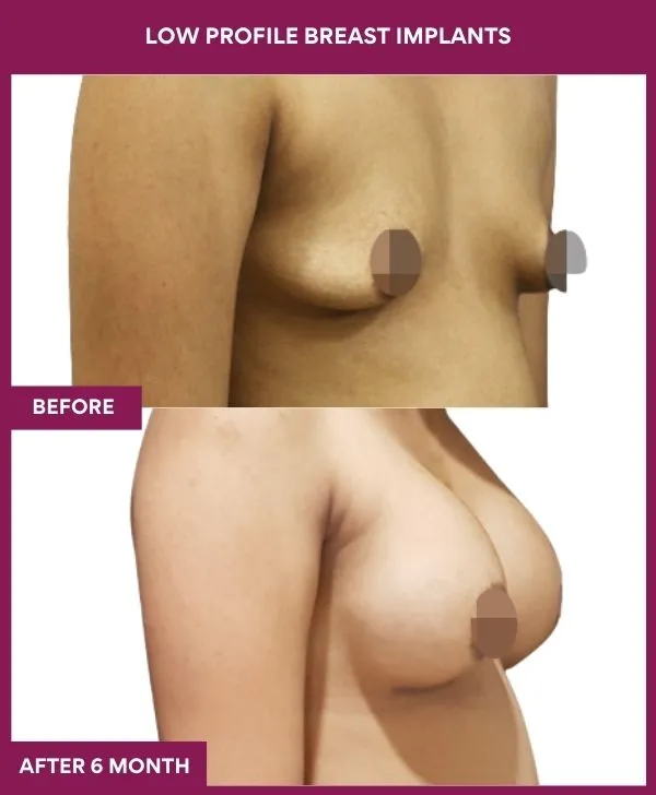 low-profile-breast-implants-before-after-results-mumbai-india-patient02-side-right