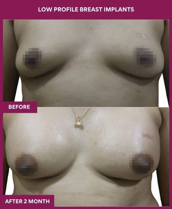 low-profile-breast-implants-before-after-results-mumbai-india-patient03-front