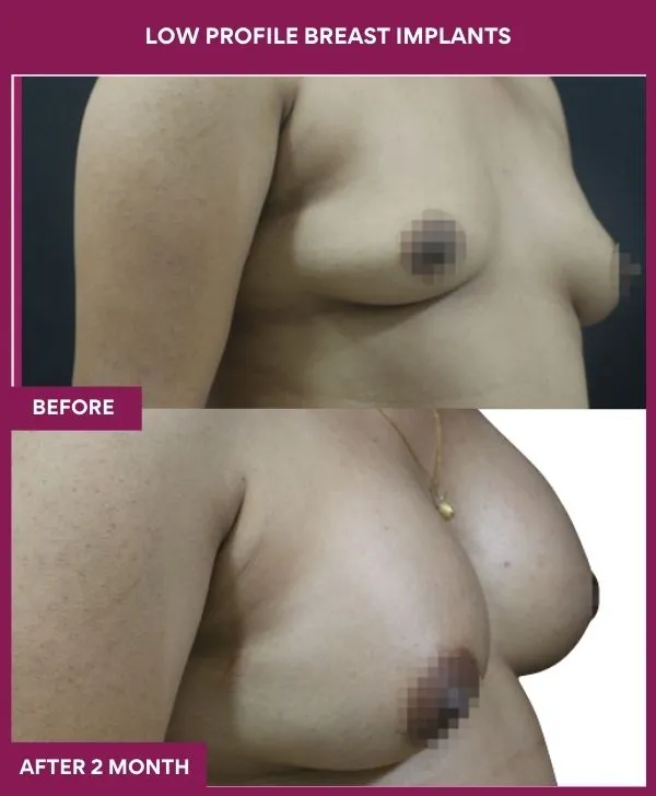 low-profile-breast-implants-before-after-results-mumbai-india-patient03-side-right