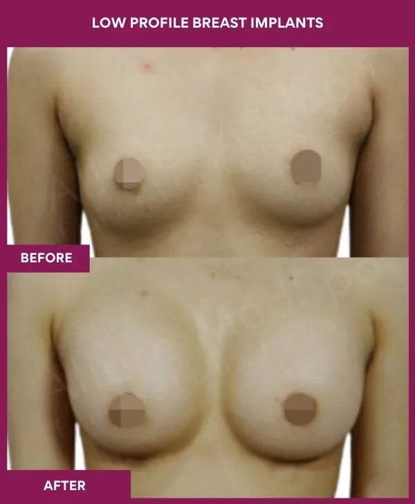 low-profile-breast-implants-before-after-results-mumbai-india-patient04-front
