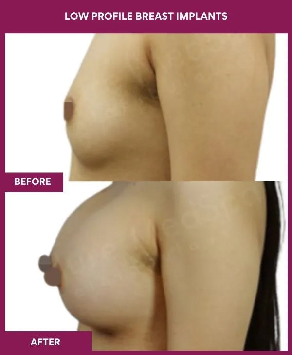 low-profile-breast-implants-before-after-results-mumbai-india-patient04-side-left