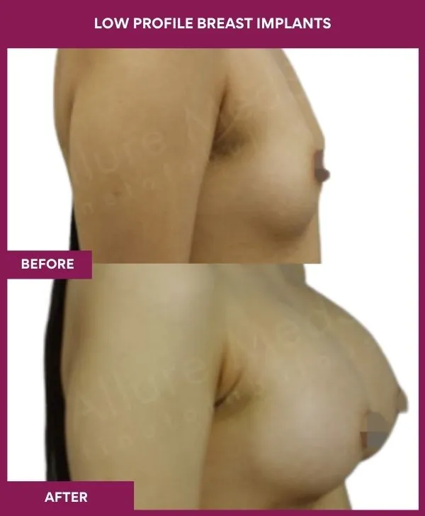 low-profile-breast-implants-before-after-results-mumbai-india-patient04-side-right