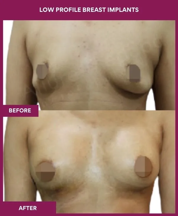 low-profile-breast-implants-before-after-results-mumbai-india-patient05-front