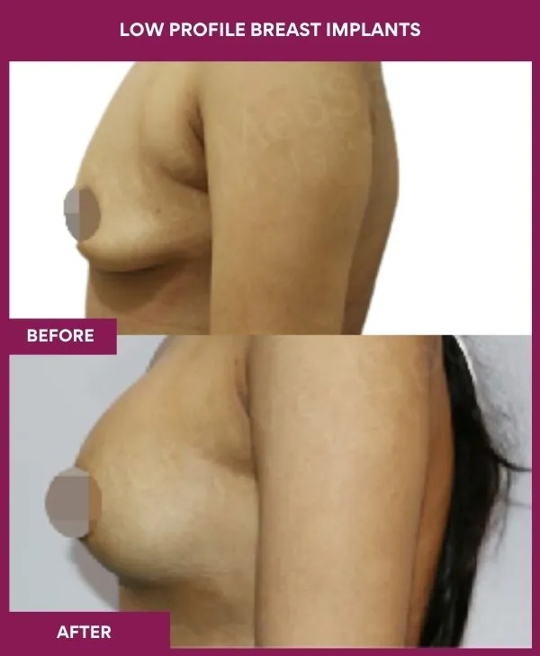 low-profile-breast-implants-before-after-results-mumbai-india-patient05-side-left