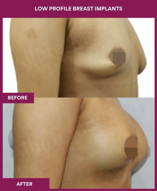 low-profile-breast-implants-before-after-results-mumbai-india-patient05-side-right
