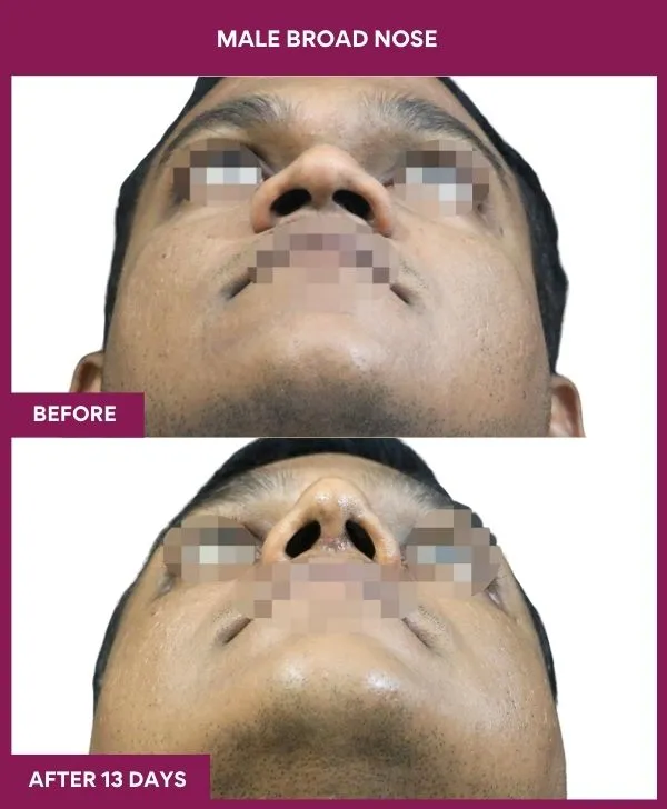 male-broad-nose-rhinoplasty-before-after-results-mumbai-india-patient01-front-up