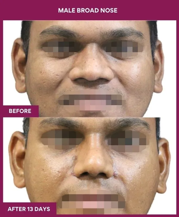 male-broad-nose-rhinoplasty-before-after-results-mumbai-india-patient02-front