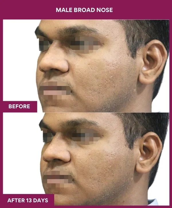 male-broad-nose-rhinoplasty-before-after-results-mumbai-india-patient02-side-left