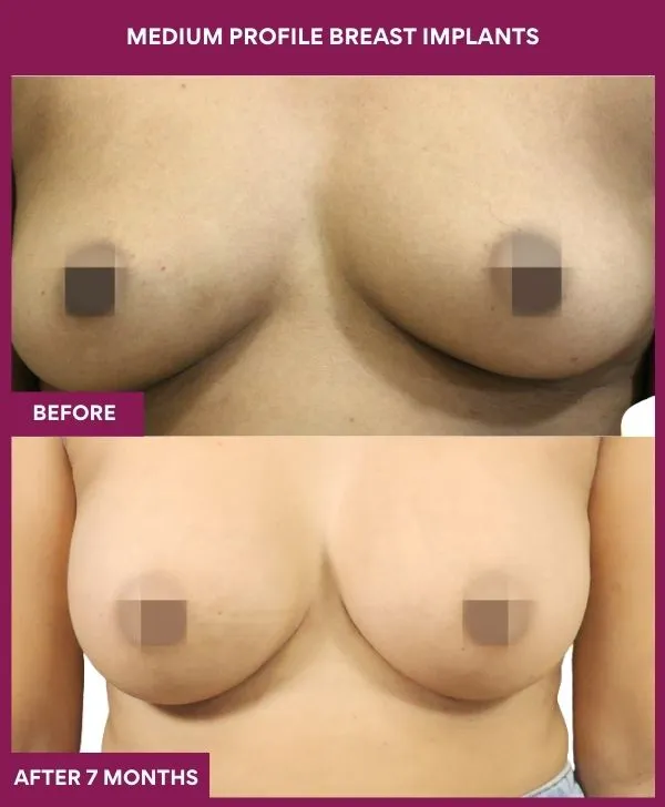 medium-profile-breast-implants-before-after-results-mumbai-india-patient01-front