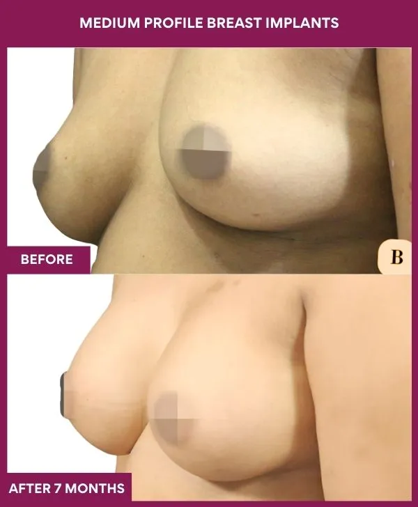 medium-profile-breast-implants-before-after-results-mumbai-india-patient01-side-left