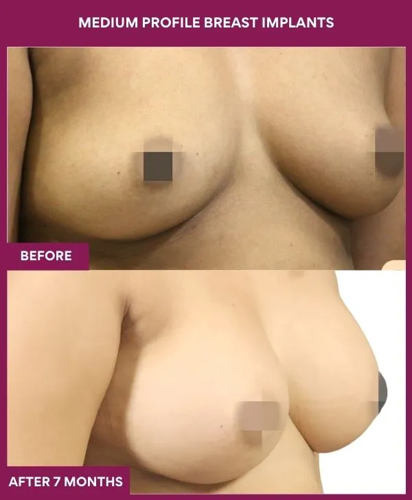 medium-profile-breast-implants-before-after-results-mumbai-india-patient01-side-right