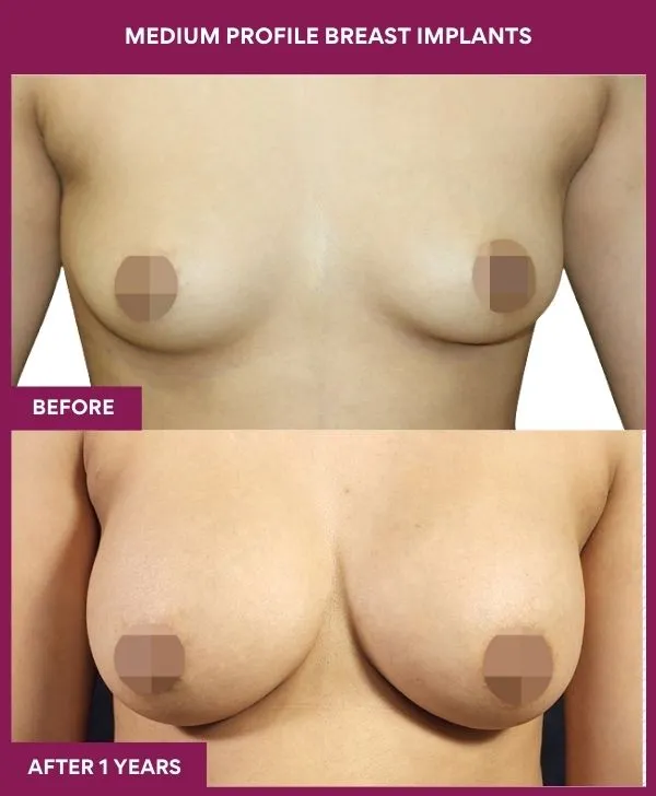 medium-profile-breast-implants-before-after-results-mumbai-india-patient02-front