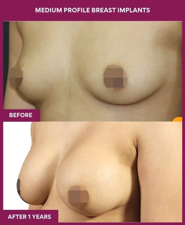 medium-profile-breast-implants-before-after-results-mumbai-india-patient02-side-left