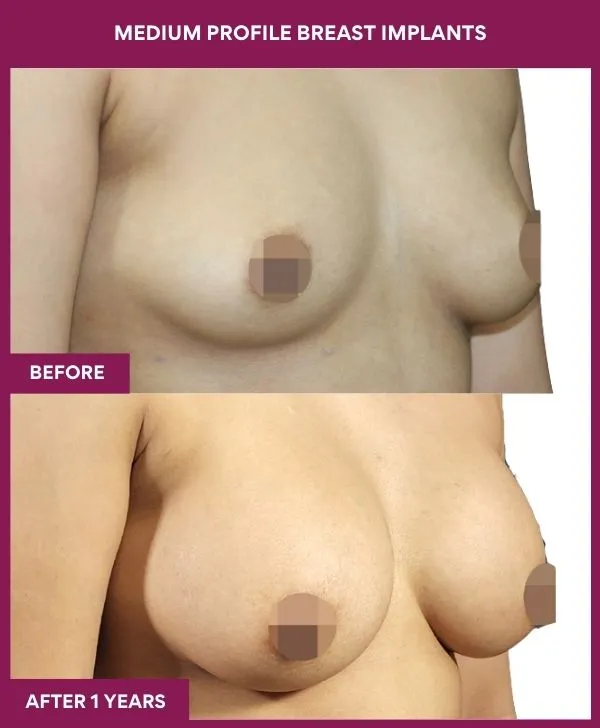 medium-profile-breast-implants-before-after-results-mumbai-india-patient02-side-right