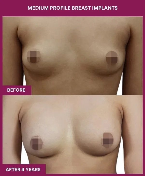 medium-profile-breast-implants-before-after-results-mumbai-india-patient03-front