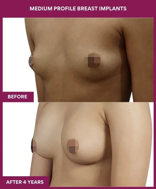 medium-profile-breast-implants-before-after-results-mumbai-india-patient03-side-left