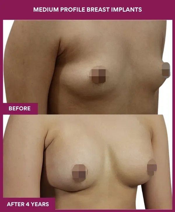 medium-profile-breast-implants-before-after-results-mumbai-india-patient03-side-right