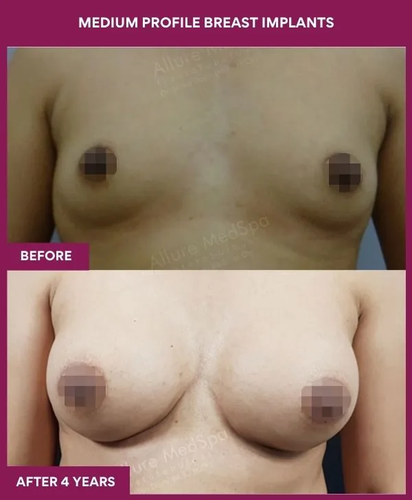 medium-profile-breast-implants-before-after-results-mumbai-india-patient04-front