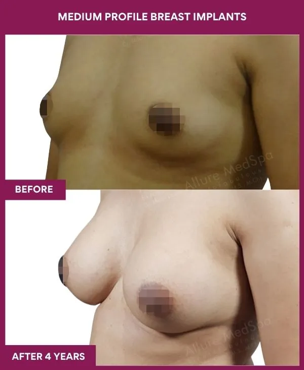 medium-profile-breast-implants-before-after-results-mumbai-india-patient04-side-left