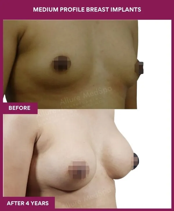 medium-profile-breast-implants-before-after-results-mumbai-india-patient04-side-right