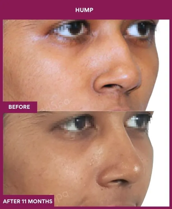 nose-hump-rhinoplasty-before-after-results-mumbai-india-patient01-front-right