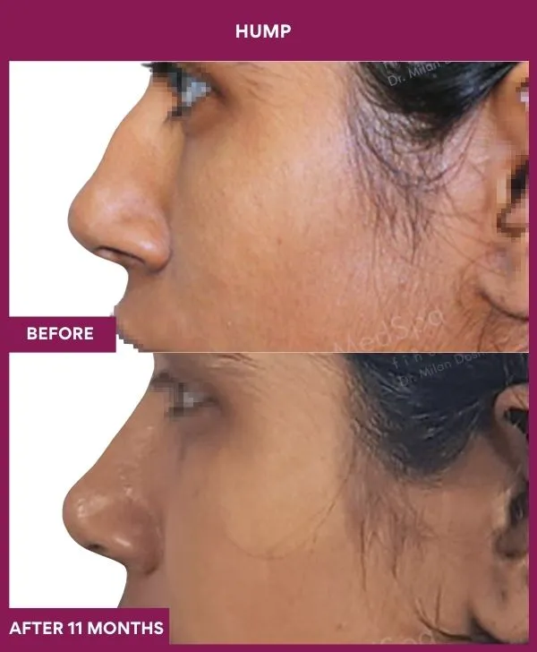 nose-hump-rhinoplasty-before-after-results-mumbai-india-patient01-side-left