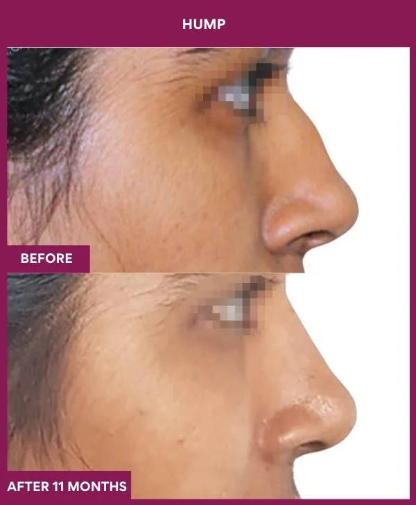 nose-hump-rhinoplasty-before-after-results-mumbai-india-patient01-side-right