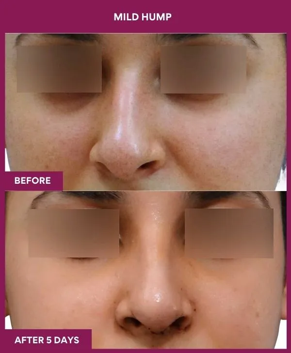 nose-hump-rhinoplasty-before-after-results-mumbai-india-patient02-front