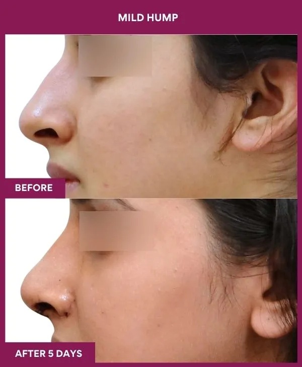 nose-hump-rhinoplasty-before-after-results-mumbai-india-patient02-side-left