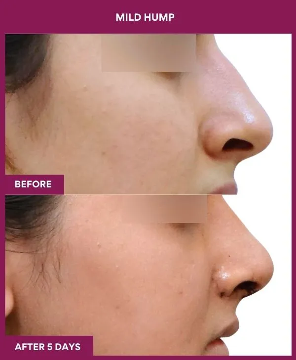 nose-hump-rhinoplasty-before-after-results-mumbai-india-patient02-side-right