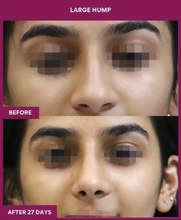 nose-hump-rhinoplasty-before-after-results-mumbai-india-patient03-front