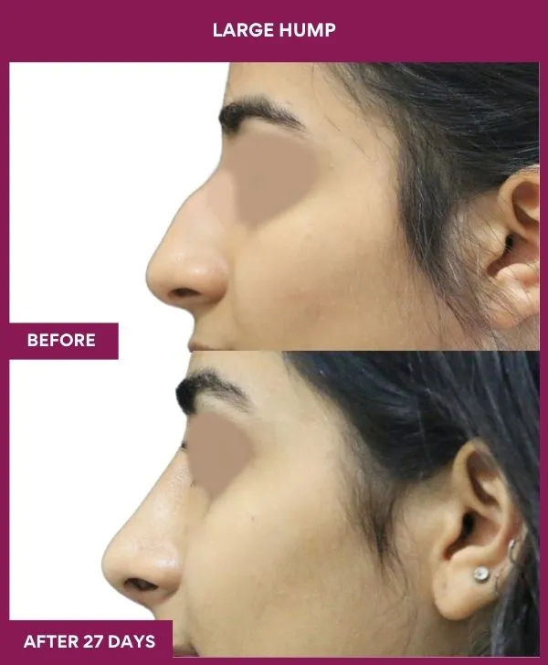 nose-hump-rhinoplasty-before-after-results-mumbai-india-patient03-side-left