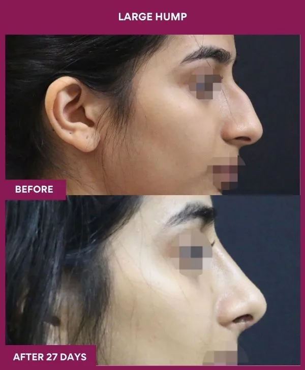 nose-hump-rhinoplasty-before-after-results-mumbai-india-patient03-side-right