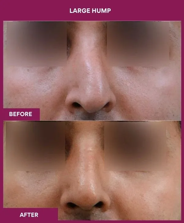 nose-hump-rhinoplasty-before-after-results-mumbai-india-patient04-front