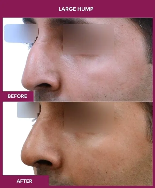nose-hump-rhinoplasty-before-after-results-mumbai-india-patient04-side-left