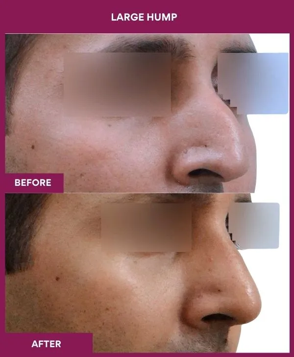 nose-hump-rhinoplasty-before-after-results-mumbai-india-patient04-side-right