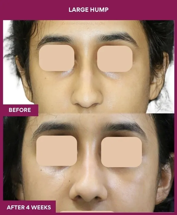 nose-hump-rhinoplasty-before-after-results-mumbai-india-patient06-front