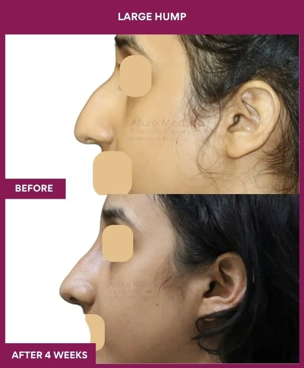 nose-hump-rhinoplasty-before-after-results-mumbai-india-patient06-side-left