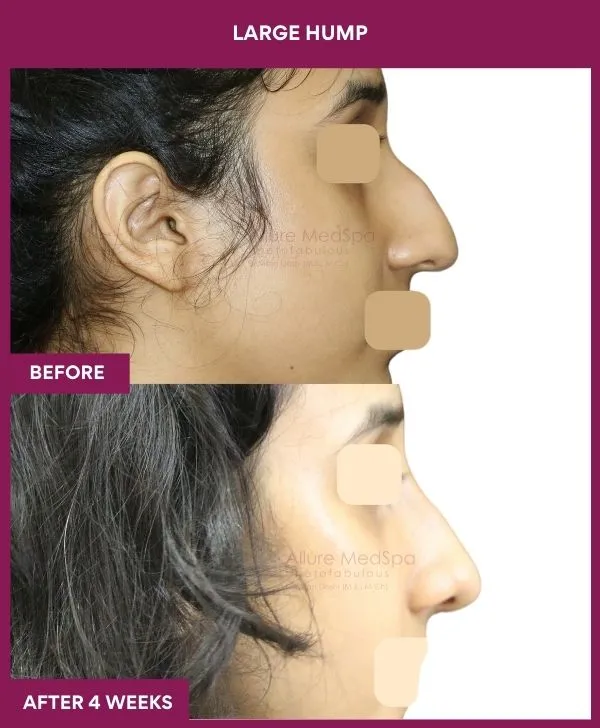 nose-hump-rhinoplasty-before-after-results-mumbai-india-patient06-side-right