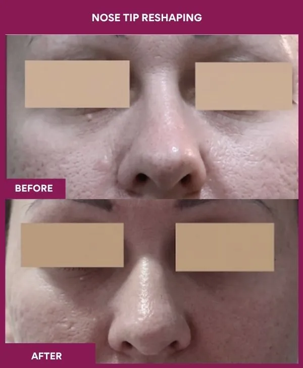 nose-tip-reshaping-before-after-results-mumbai-india-patient01-front