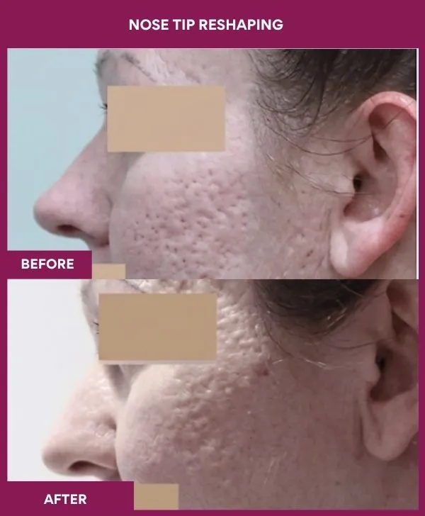 nose-tip-reshaping-before-after-results-mumbai-india-patient01-side-left
