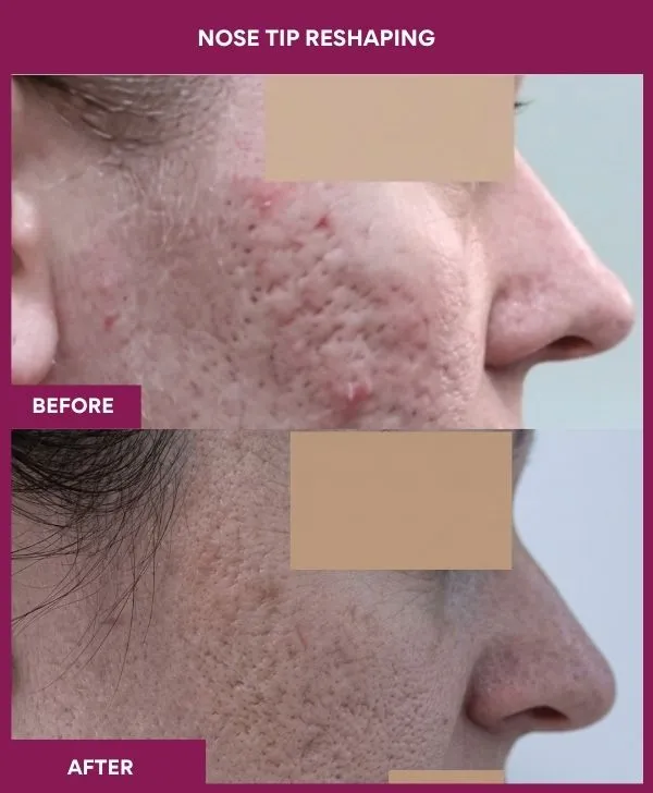 nose-tip-reshaping-before-after-results-mumbai-india-patient01-side-right