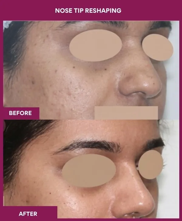 nose-tip-reshaping-before-after-results-mumbai-india-patient02-front-right